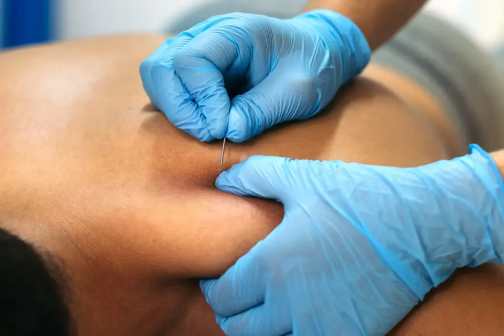 Close-up of a healthcare professional treating a patient using the dry needling procedure at a physiotherapy and muscle recovery clinic.